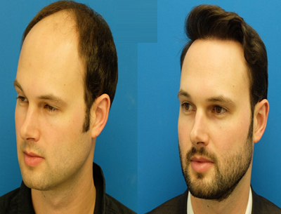 Hair Bonding Service