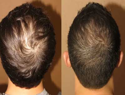 Non Surgical Hair Replacement Service